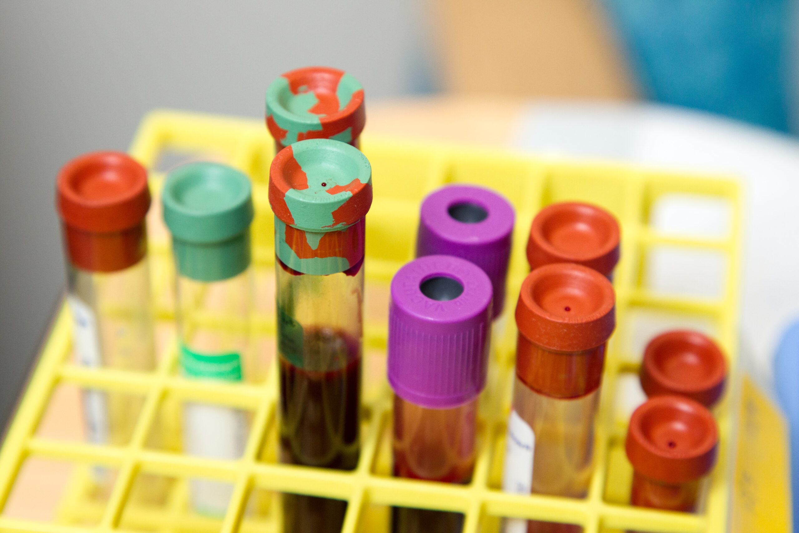 Cientistas desenvolvem novo exame de sangue que pode diagnosticar seu nível de depressão