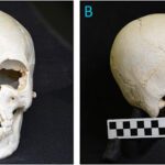 Crânio encontrado em ilha do Caribe mostra evidências de hanseníase