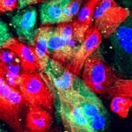 Novo tratamento para câncer de próstata: NanoKnife usa eletricidade para matar células cancerígenas