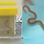 Encontrar um verme cerebral vivo é raro: 4 maneiras de se proteger de parasitas mais comuns