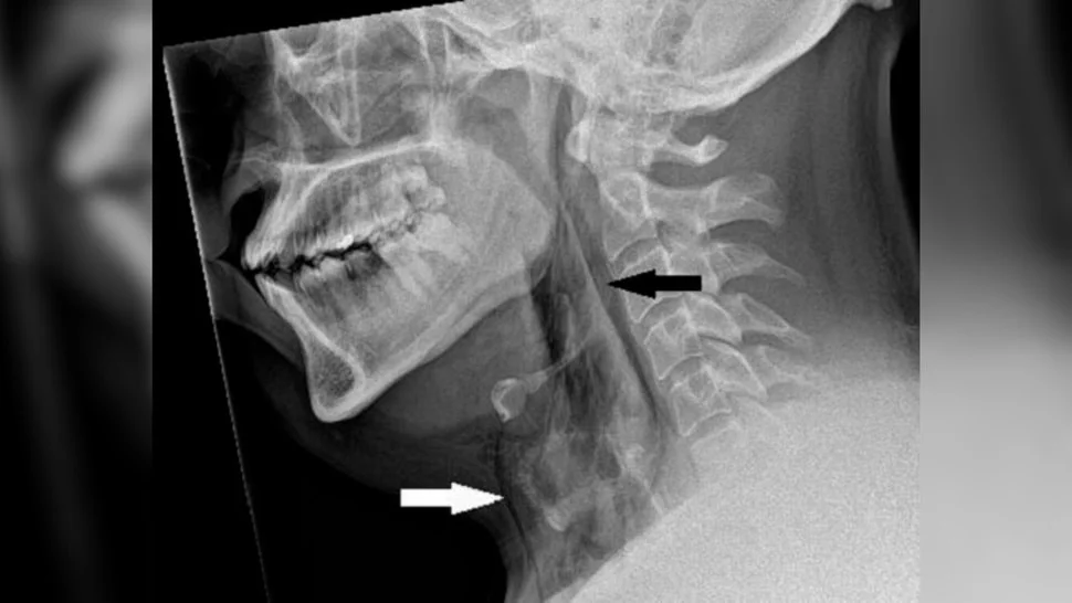 Radiografia de um pescoço