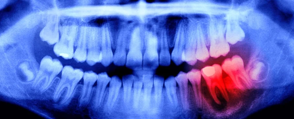 raio-x de dentes em azul com uma parte marcada em vermelho