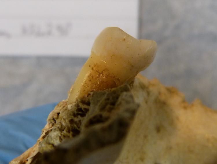 um dente amarelado encrustado encrustado em um pedaço de crãnio