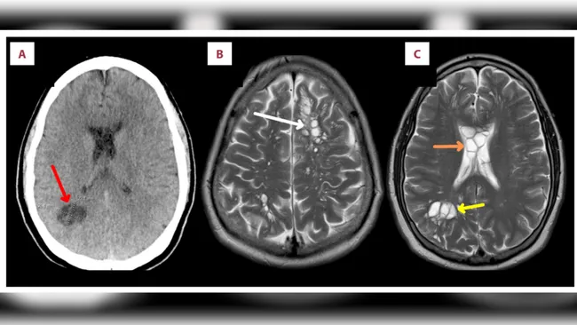 três imagens de ressonância da cabeça de um paciente com larvas de tênia crescendo no cérebro