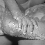 Epidemia de varíola: dos primeiros casos às vacinações