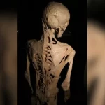 Doença do homem de pedra: uma condição rara que faz com que uma pessoa desenvolva um segundo esquele...