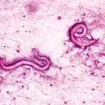 Corpo de homem infestado de vermes parasitas após transplante de rim infectado em hospital dos EUA