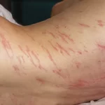 Erupção cutânea 'migrou' do ânus para o corpo de um homem