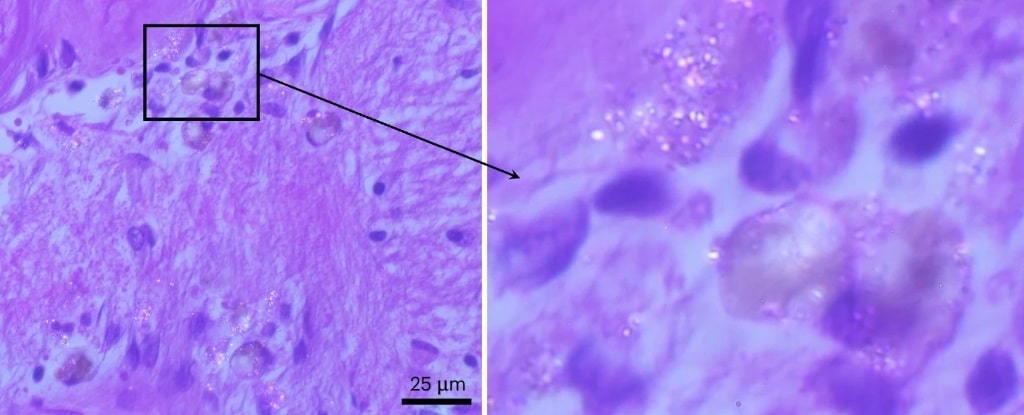 Tecido cerebral de paciente com demência (à esquerda) com reflexos de plástico (à direita). 
