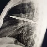 Uma faca quebrou no peito de um homem e ele não percebeu por 8 anos