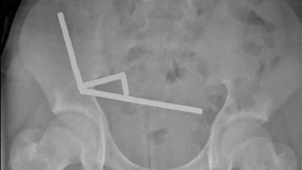 Imagem de raio-X de ímãs no abdômen. 