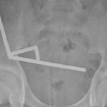 Adolescente neozelandês perde parte do intestino após engolir quase 200 ímãs