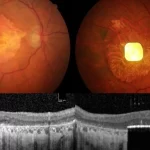 Pequeno implante ocular alimentado por IA ajuda cegos a enxergar novamente