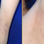 Vazamento de leite pelas axilas de uma mulher revelou 'mamas ectópicas'