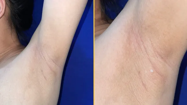 A cada parto, uma mulher notava secreções leitosas saindo de suas axilas