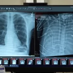 Ele aguentou 48 horas sem pulmões e viveu