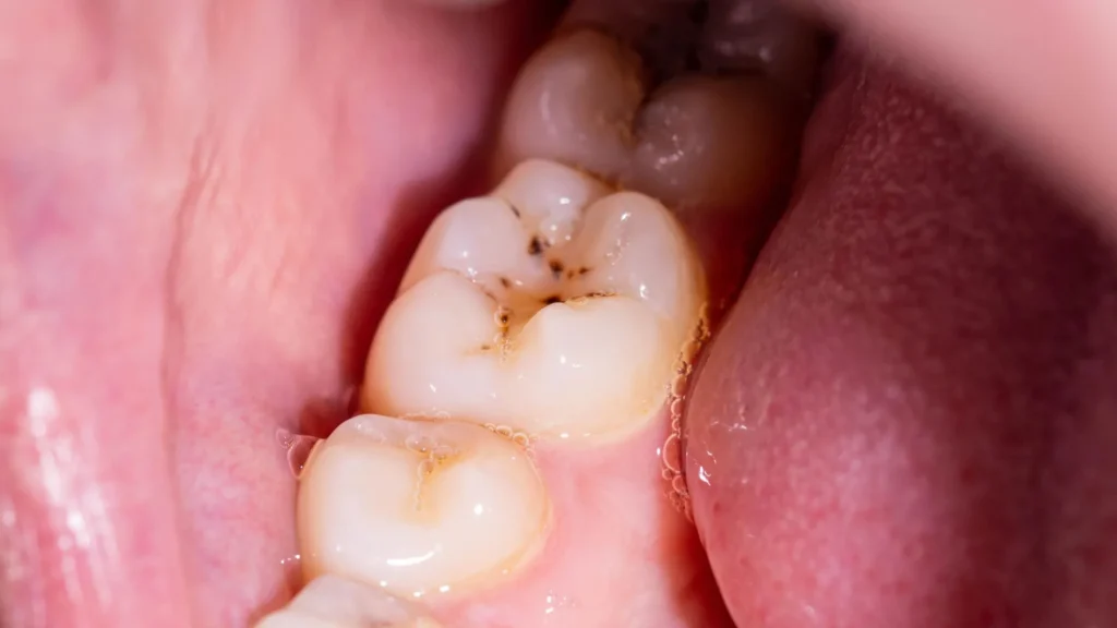 Um novo gel pode ajudar os dentes a reconstruir o esmalte perdido, utilizando minerais já presentes na saliva.
