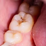 Adeus, cáries? Um novo gel pode regenerar o esmalte dos dentes