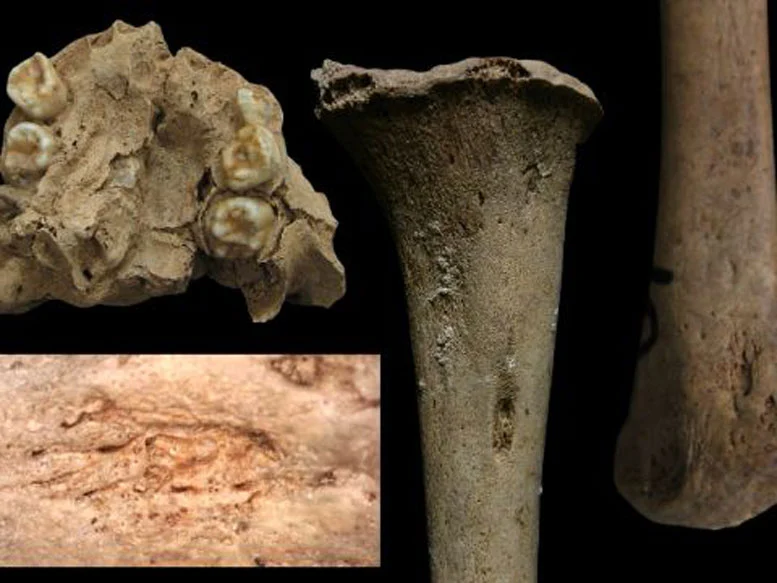 Doenças dentárias e esqueléticas indicam fortemente a transmissão da doença treponêmica da mãe para o bebê no útero. 